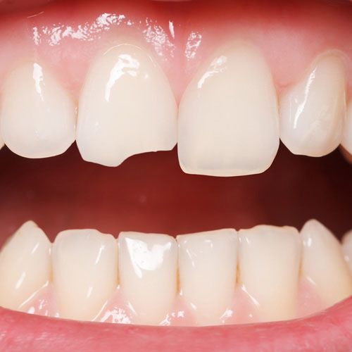 Chipped front tooth before composite bonding