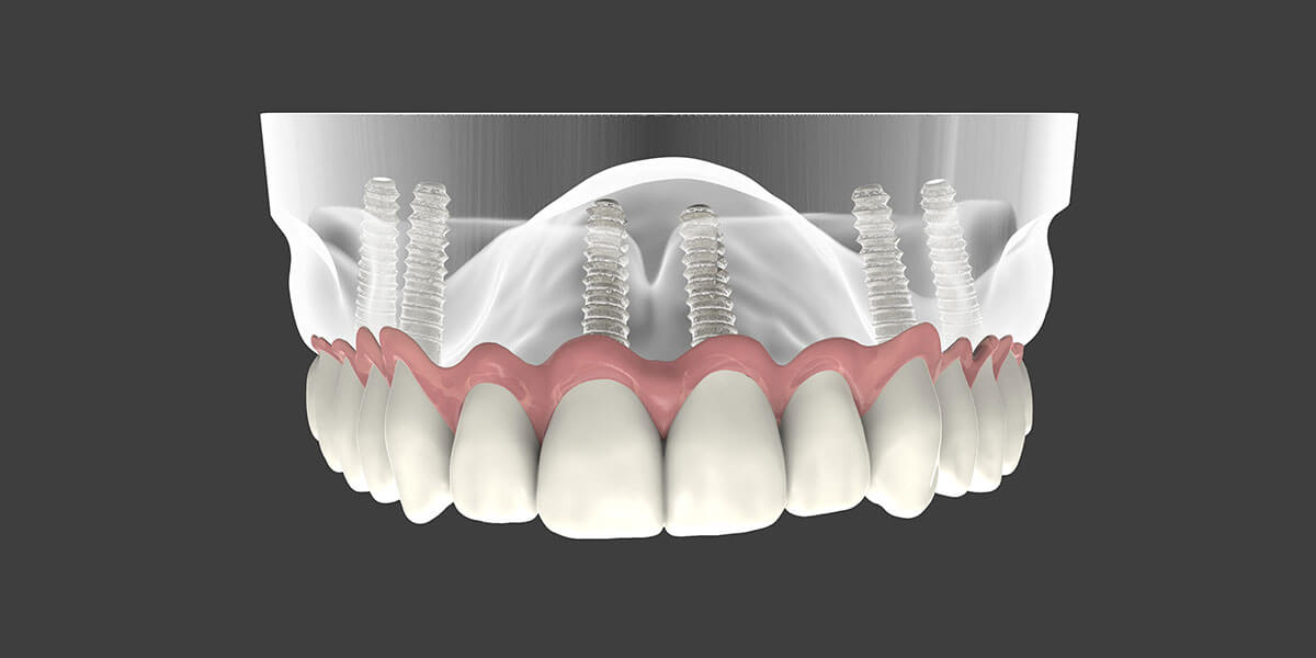 Full upper arch restoration supported by dental implants — teeth anchored permanently into the jaw