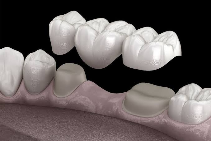 Dental bridge illustration
