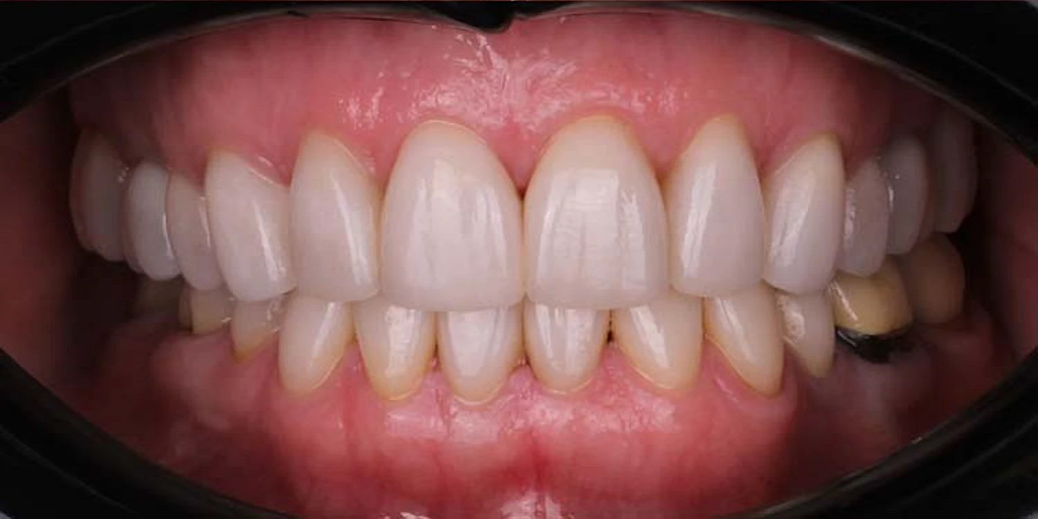 After full-mouth porcelain veneers: even length, uniform colour and a corrected bite