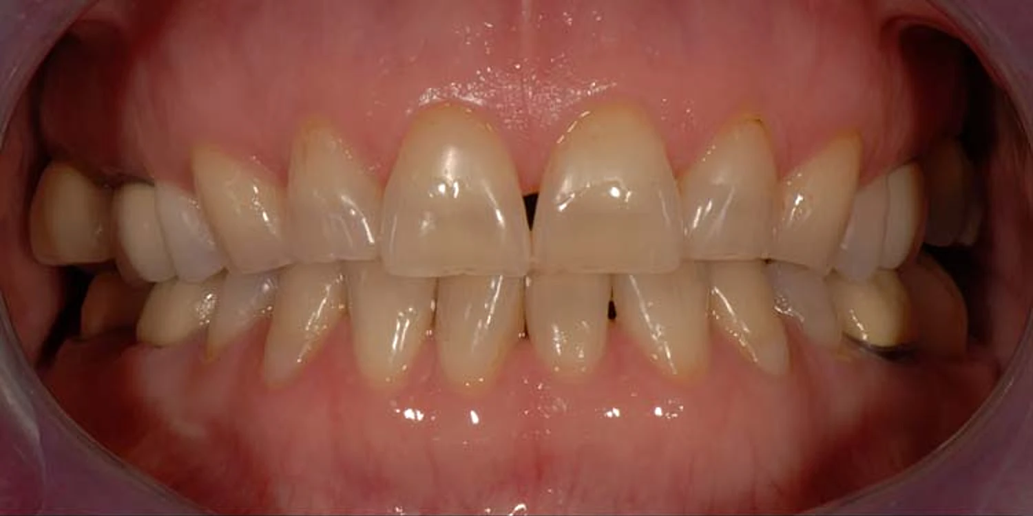 Before treatment: worn, yellowed teeth with gumline staining and dark older restorations
