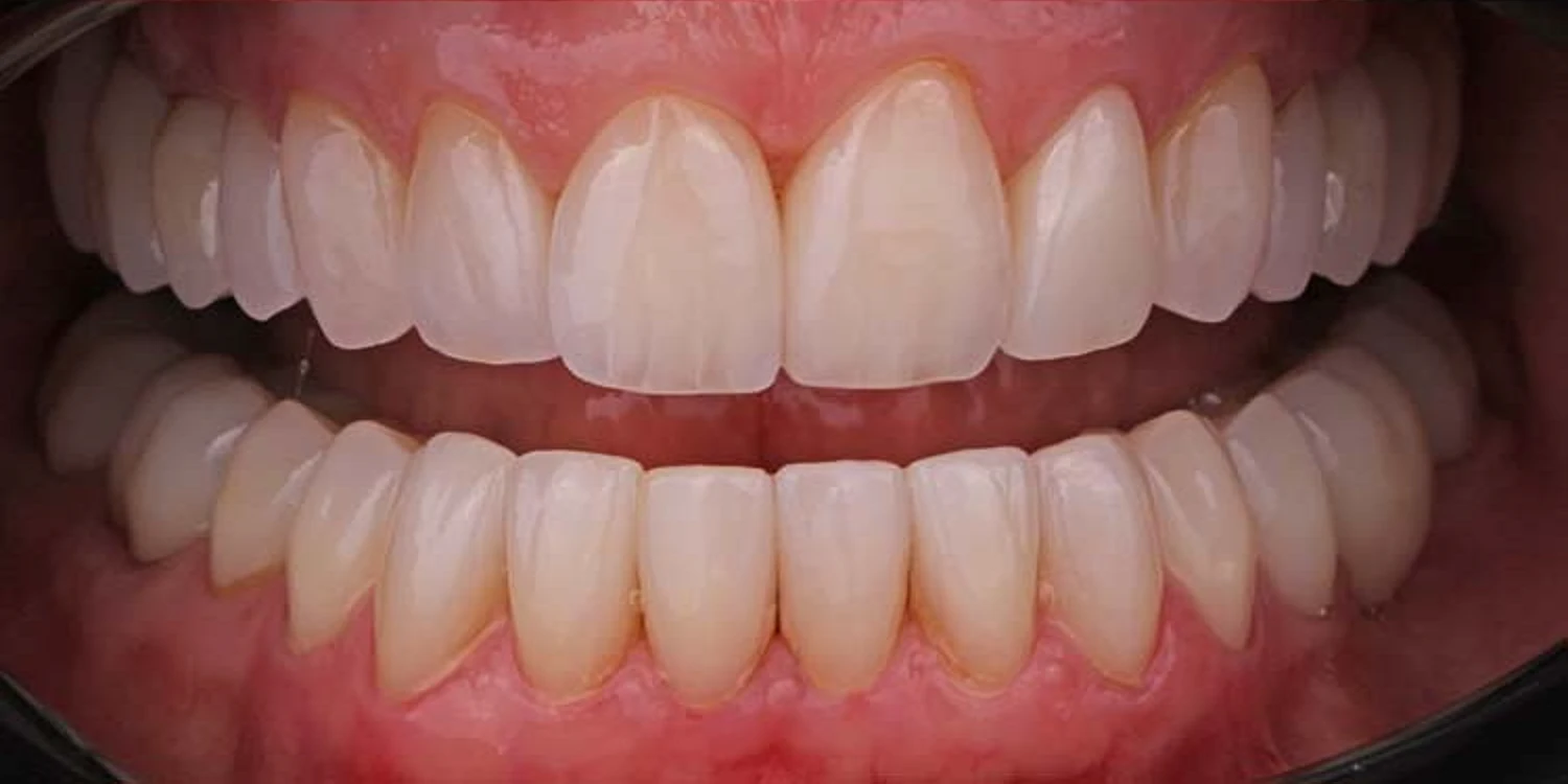 After lower-arch veneers: upper and lower teeth matched in length and colour