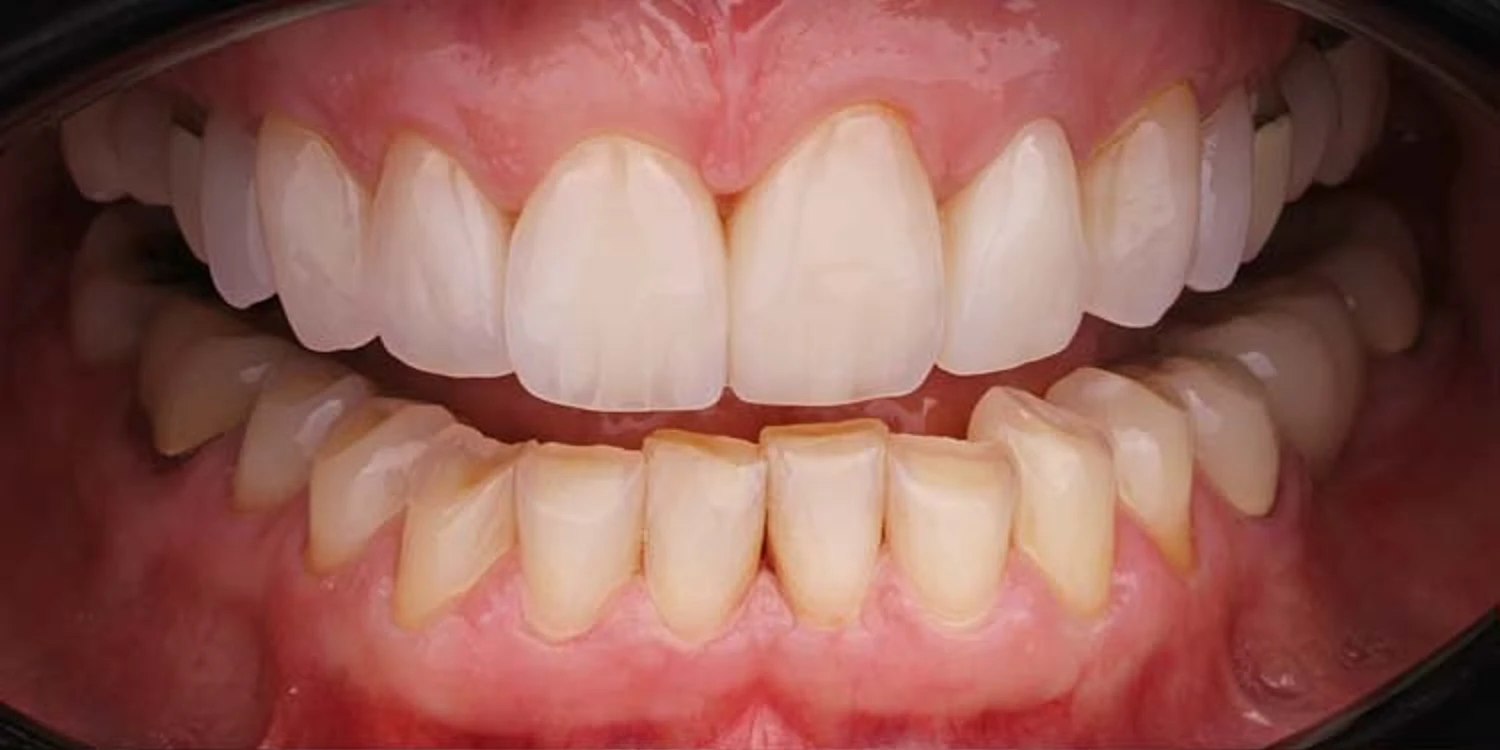 Before treatment: lower teeth worn short and uneven with yellowing along the edges