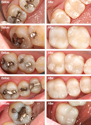 Five before-and-after cases of silver amalgam fillings replaced with natural tooth-colored composite fillings