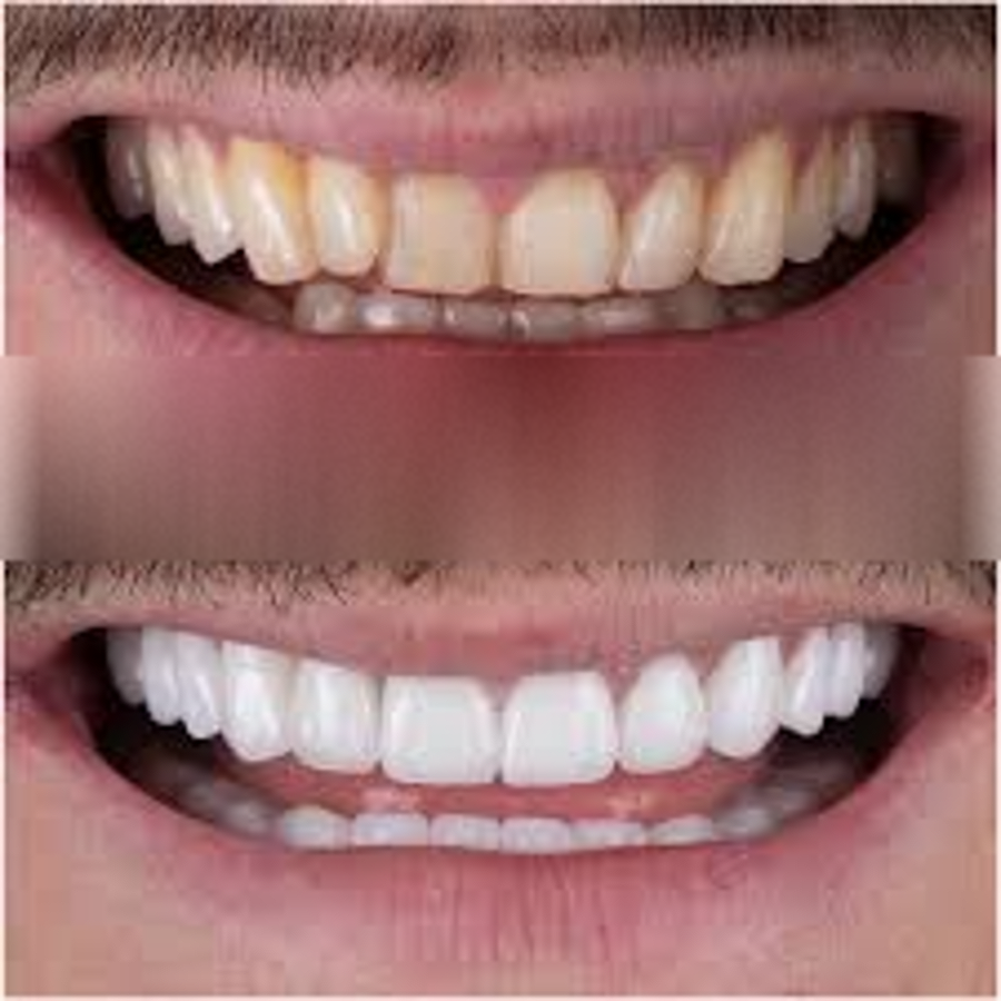 Discolored teeth before and after composite bonding