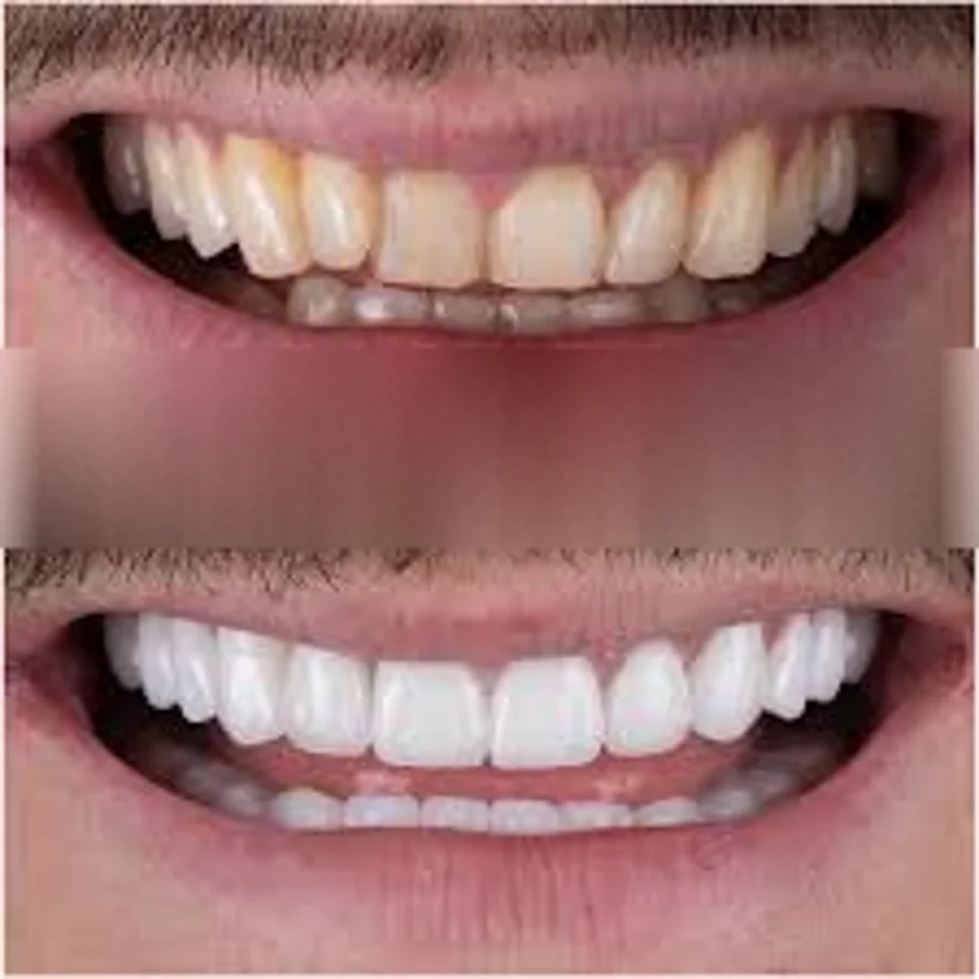 Close-up of tooth enamel discoloration