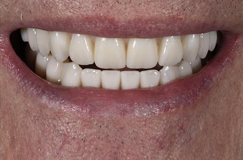 After implant treatment