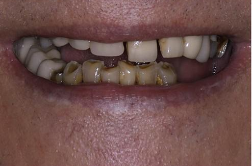 Before implant treatment