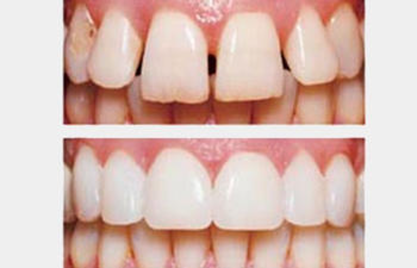 Gap teeth closed with composite bonding
