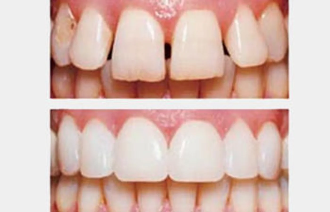 Gap teeth closed with composite bonding