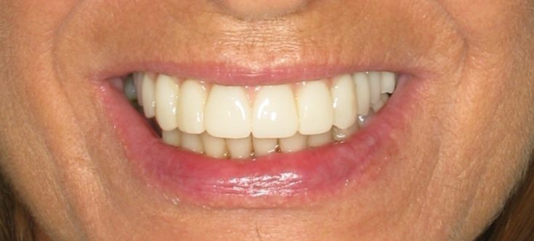 After implant-retained denture treatment