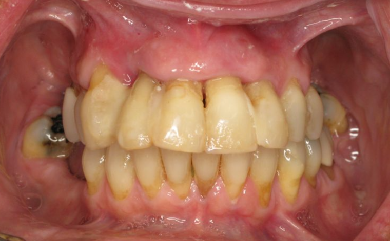 Before implant-retained denture treatment