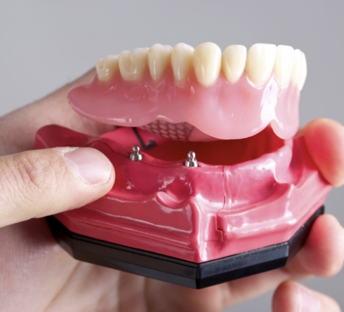 Model showing a snap-in overdenture clicking onto two implant attachments in the lower jaw