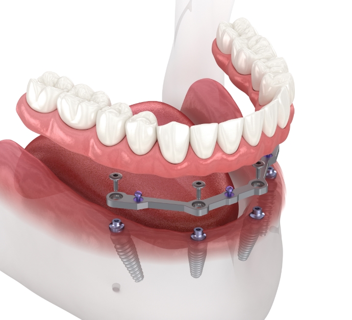 Fixed All-on-6 implant denture — lower full arch secured on a bar supported by six dental implants