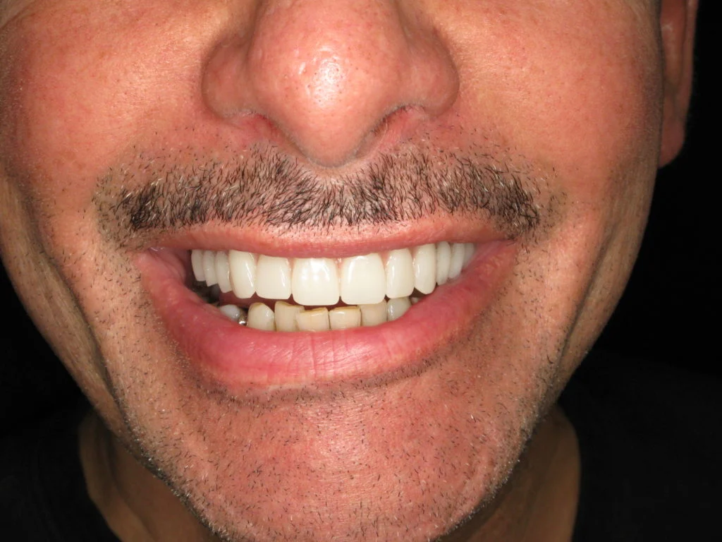 After — full, natural upper smile on a fixed implant denture