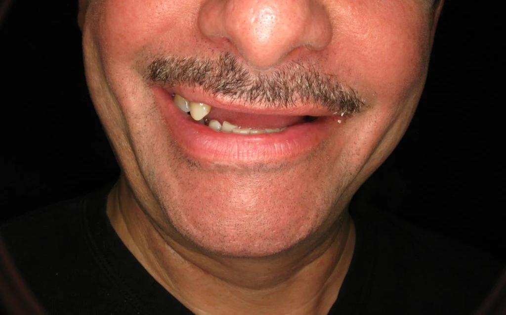 Before — patient with missing and worn upper teeth