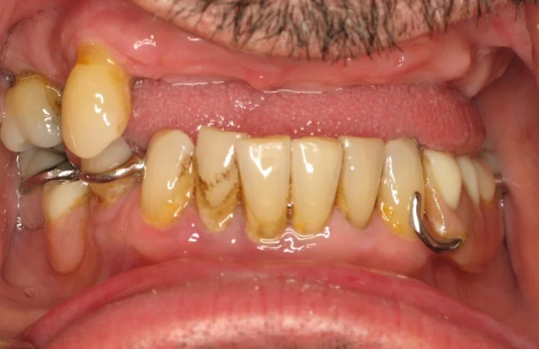 Before β worn teeth with a metal-clasp partial denture