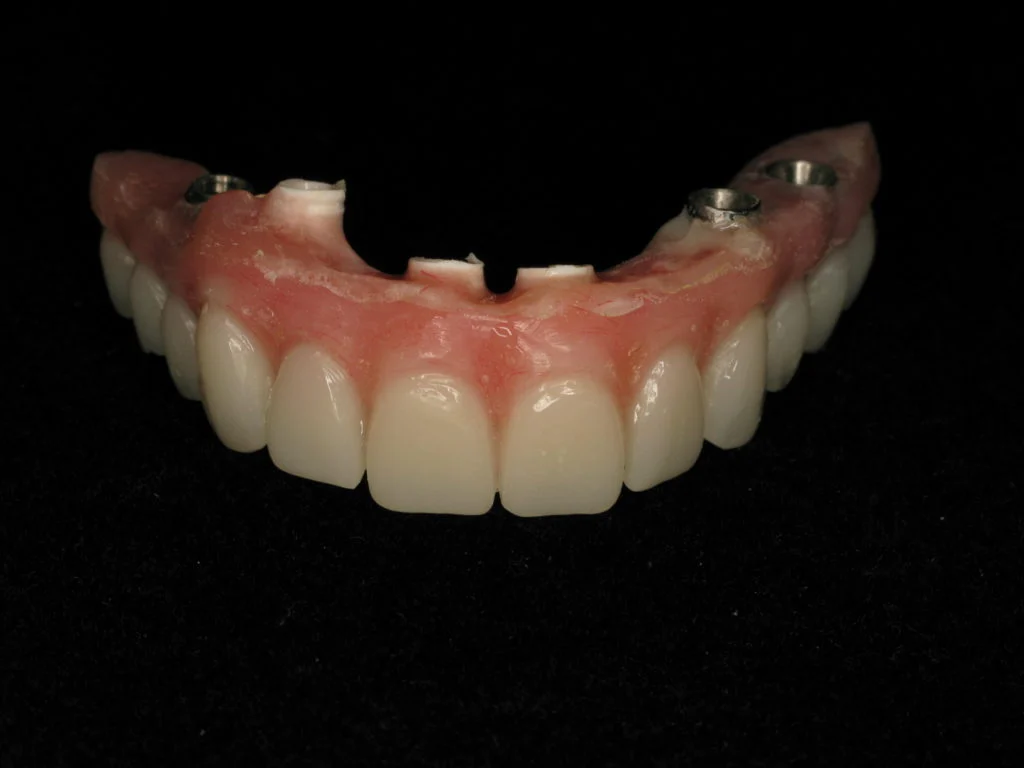 The custom fixed upper implant denture before placement