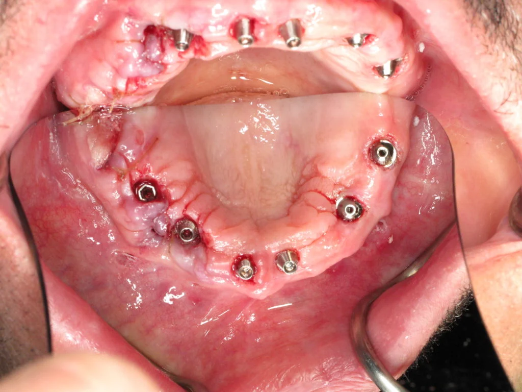 Clinical photo — dental implants placed in the upper and lower arches