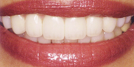 After veneer treatment