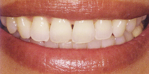 Before veneer treatment