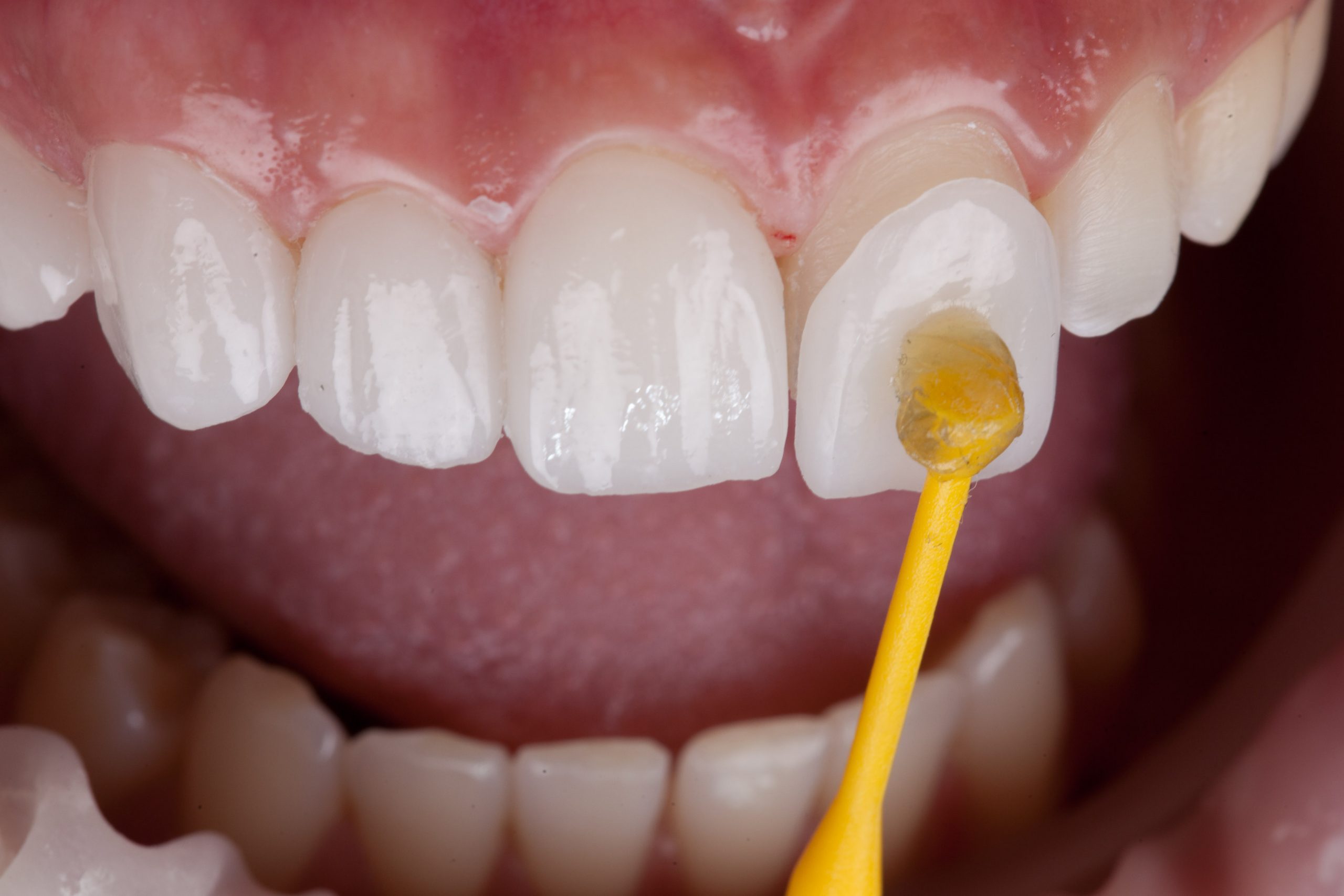 Porcelain veneers