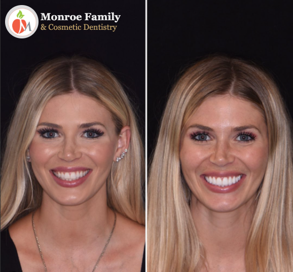 Smile Makeover Before & After