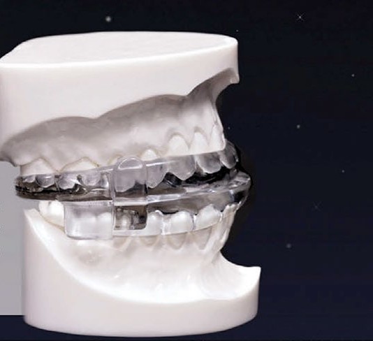 MicroO2 custom oral appliance for sleep apnea fitted on a dental model