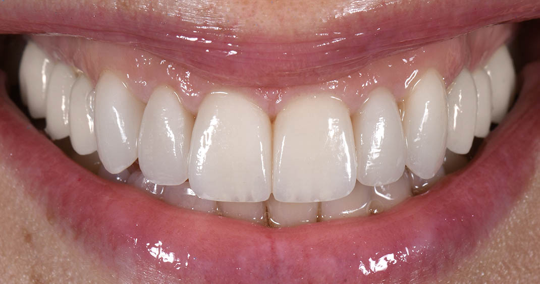 After porcelain veneers: ten units restoring length, an even smile line and natural brightness