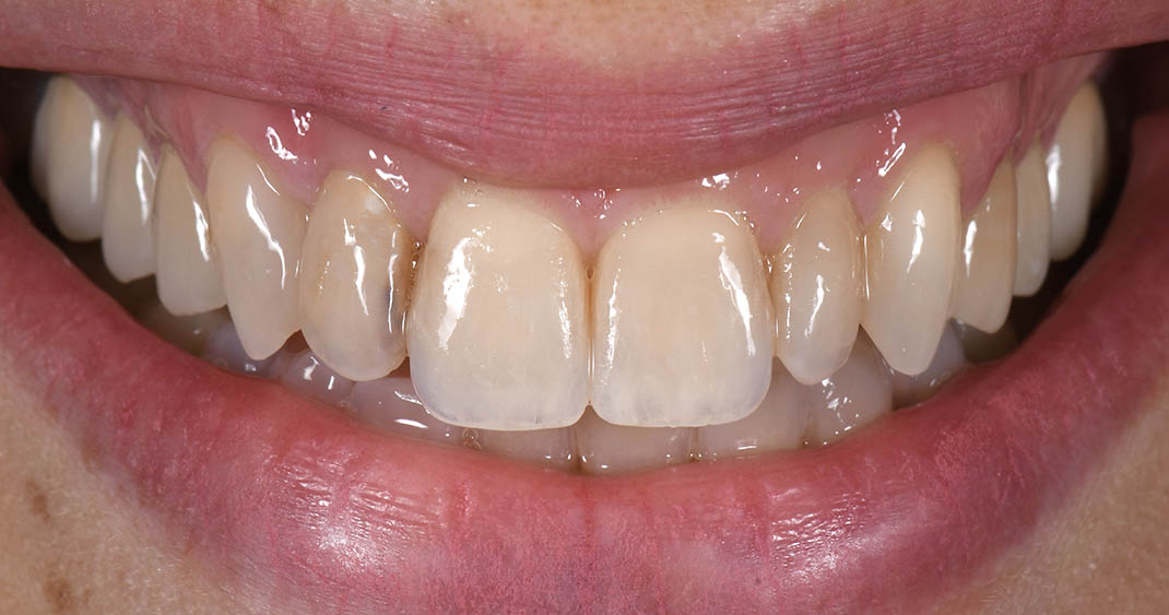 Before porcelain veneers: short, uneven upper front teeth with translucent greying edges and an irregular smile line