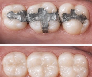 Before and after: old silver amalgam fillings replaced with natural white composite fillings